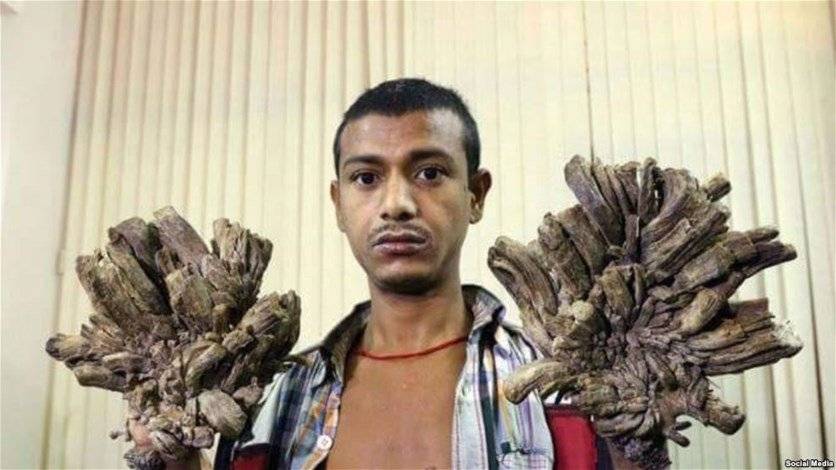 بالصور: "الرجل الشجرة" يستعيد يديه وحياته
