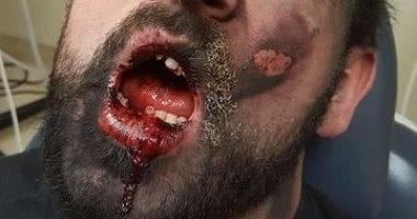 بالصور: شيئ نستخدمه يومياً شوه فم هذا الرجل