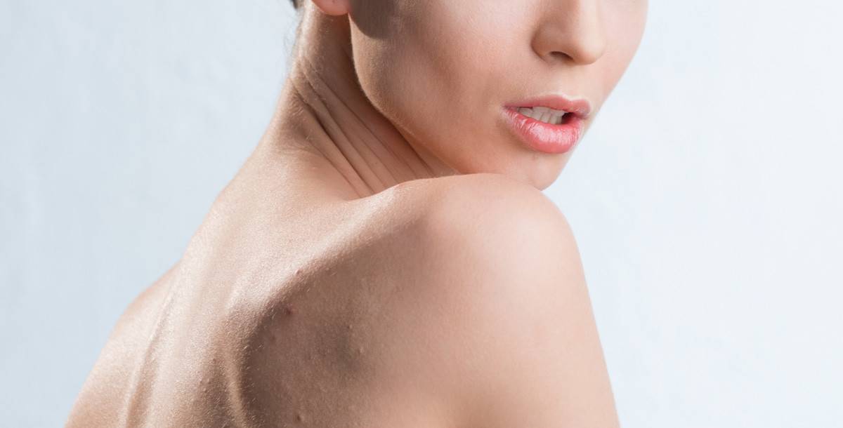 مكان حب الشباب على جسدك يكشف عن مشكلاتك الصحية!