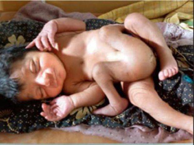 ولادة طفل بأربعة أرجل وجهازين تناسليين في الهند