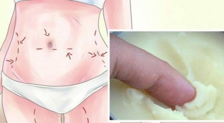 تخلصوا من علامات تمدد الجلد والندوب المزعجة بمكون واحد فقط!