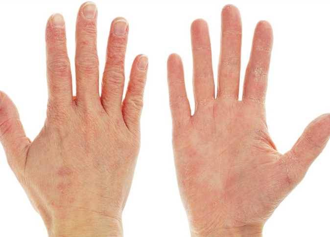 10 دقائق فقط تقضي على جفاف اليدين القوي