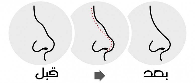 عمليات تجميل الانف و تقويم الحاجز الانفي