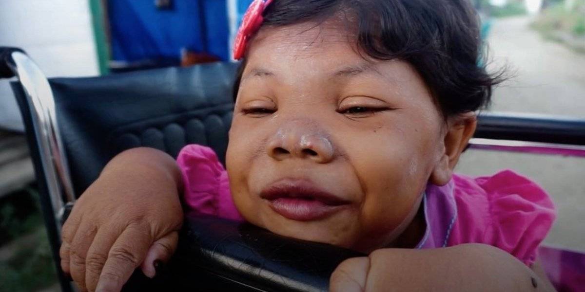 مرض نادر يجعل طفلة في عمر 24 تبدو وكأنها 4 سنوات