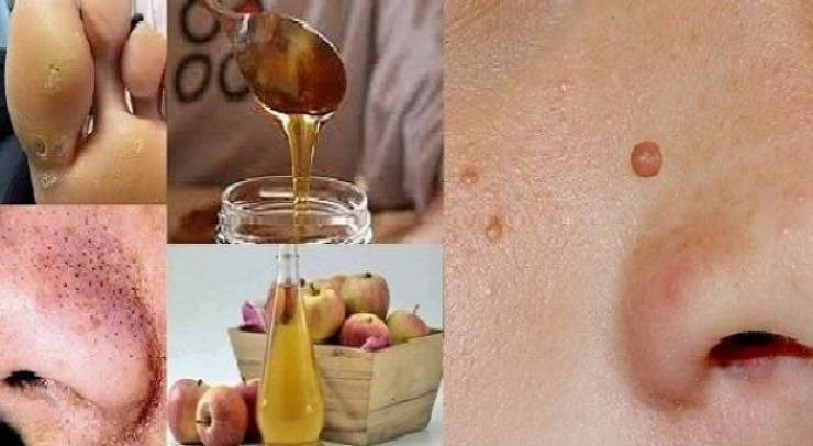 إليك هذه الطريقة للتخلص من الشامات والبقع البنية والبثور!