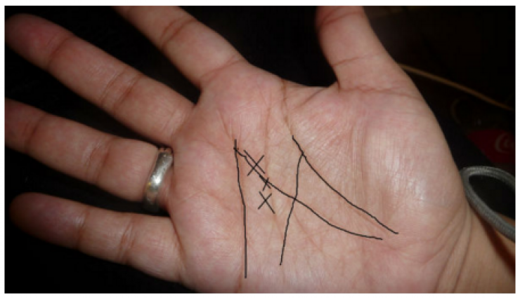 هل يظهر الحرف ' X ' على راحة يدك؟