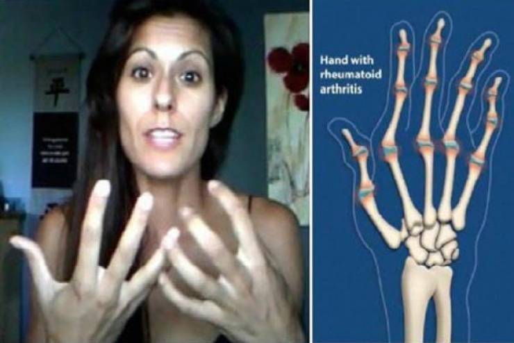 وجدت علاجاً لالتهابات مفاصلها وشفيت تماماً.. اليكم ما فعلته!