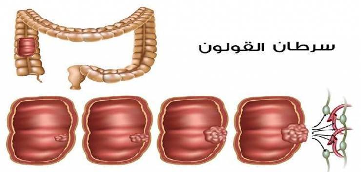 5 خطوات لتحموا أنفسكم من سرطان القولون