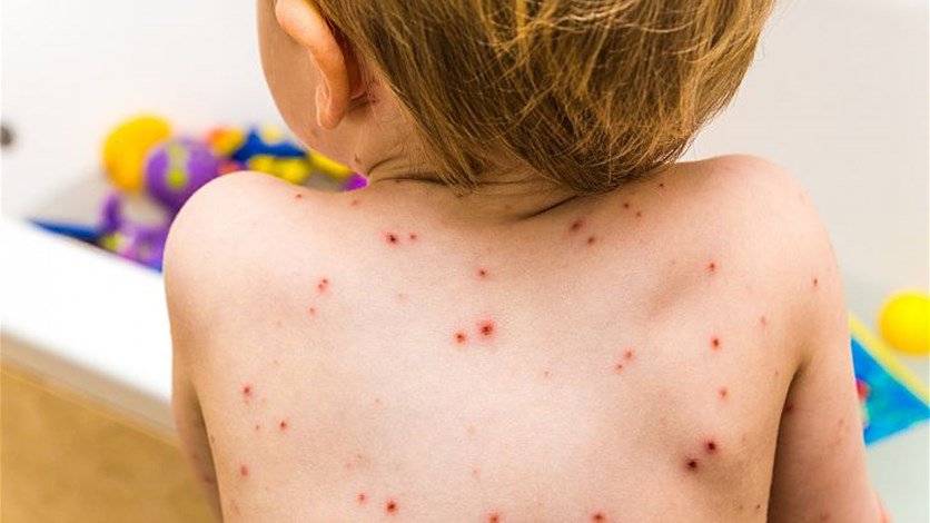 علاجات منزلية سهلة وفعالة للتخلص من الجدري