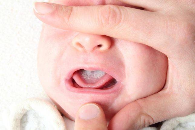 "اللسان المربوط" عند الأطفال.. الأعراض والعلاج!