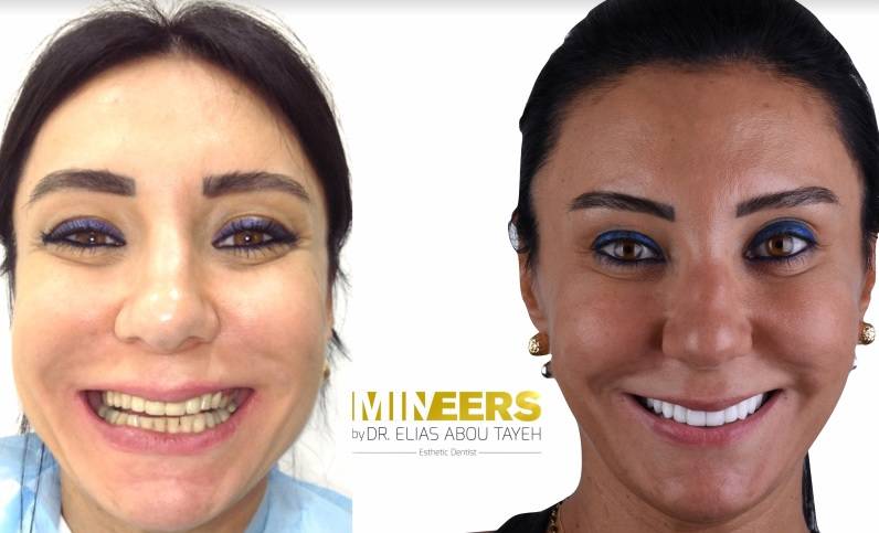 الـ»Mineers smile« ثورة في عالم تجميل الأسنان