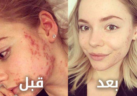 تخلت عن هذا النوع من الطعام فتخلصت نهائيا من حب الشباب