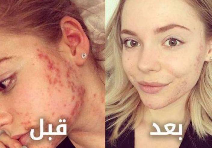تخلت عن هذا الطعام فتخلّصت من حب الشباب نهائياً!
