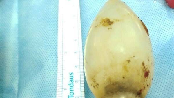 إستخراج "لمبة" من بطن شاب ظلت 15 عاماً