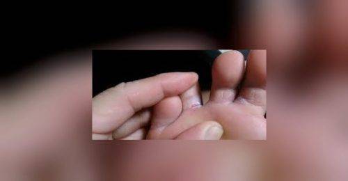 هل تعانون من فطريات القدم .. اليكم الحل
