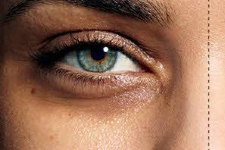 الهالات السوداء.. كيف تتخلص منها نهائيا؟!