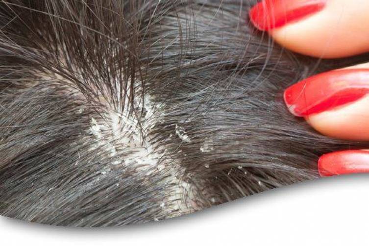 كيف تتخلصين من قشرة الرأس