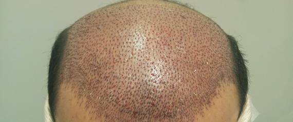 أقوى عملية زرع شعر.. لا تفوتوها!!