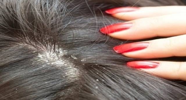 خلطة منزلية للتخلص من قشرة الشعر في أسبوع!!