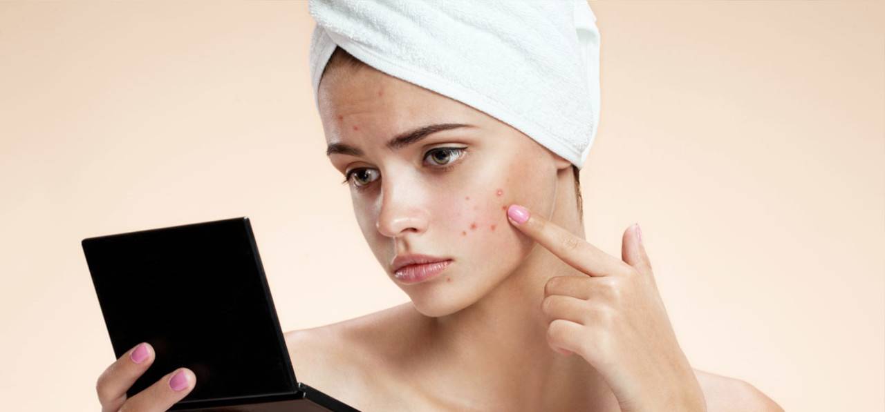 10 ممارسات توقف عنها إذا كنت تعاني من حب الشباب