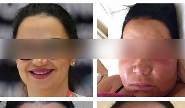 "باسمة" ضحية جديدة في عالم التجميل.. فمن المسؤول؟