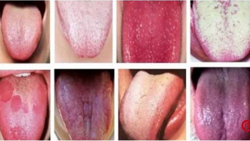 هذه هي الخفايا الصحية التي يكشفها لون لسانكم!