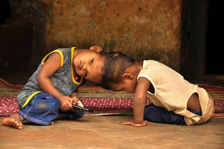 بالصور: معاناة توأم ملتصق من الرأس.. هذه قصتهم!