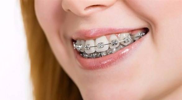 تقويم الأسنان متى يكون ضرورياً؟