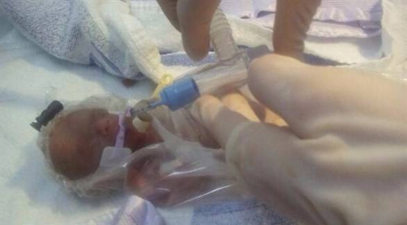 طفلة معجزة بحجم كرة تنس تتحدى توقعات الأطباء!