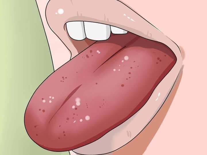 هل تعانون من تقرّحات اللسان؟ اليكم طريقة علاجها!