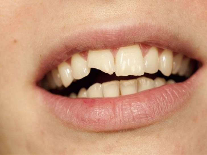 6 أطعمة تدمر أسنانك.. تعرف إليها
