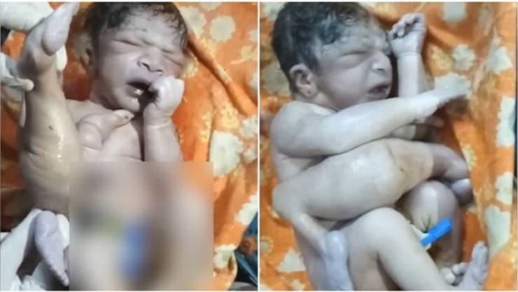 فيديو: طفل يولد بـ4 سيقان و3 أذرع.. وهذا ما فعلته به عائلته!