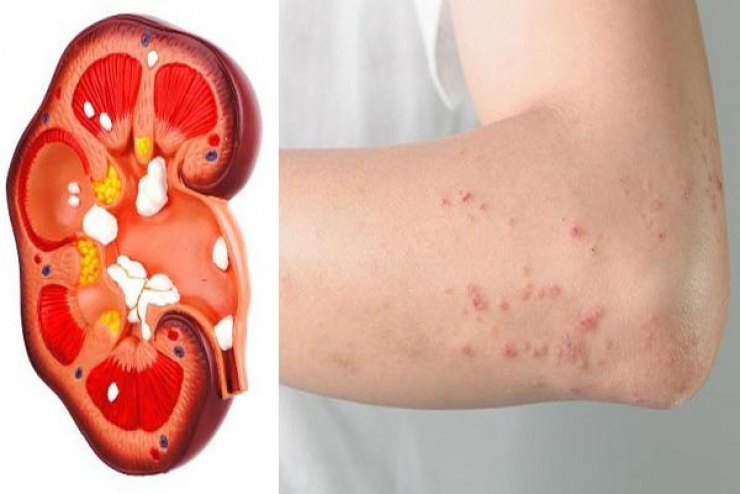 عندما تكون كليتاكم في خطر.. سيعطيكم الجسم 6 علامات بذلك
