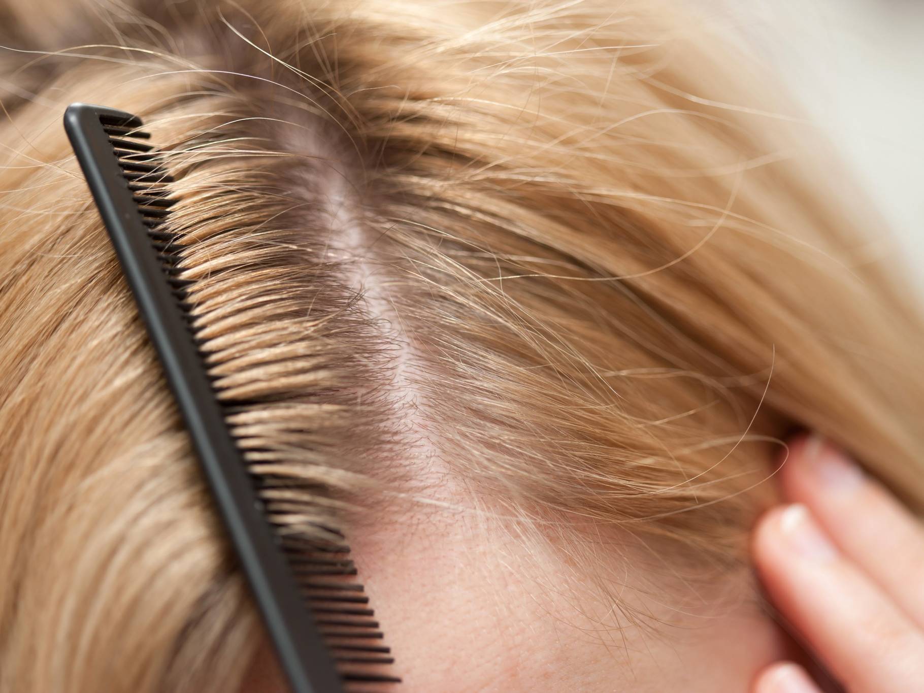 4 خلطات منزلية للتخلص من قشرة الشعر