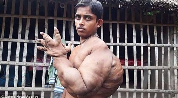 شاب يملك مخالب في إحدى يديه بسبب حالة نادرة!