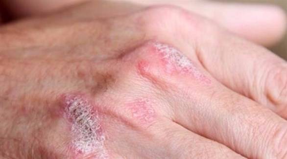 الماء والملح ساعة يومياً يخلصك من الصدفية!
