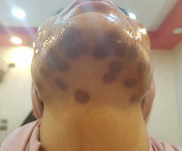 سيدة خضعت لجلسة ليزر فتعرضت لحروق من الدرجى الاولى