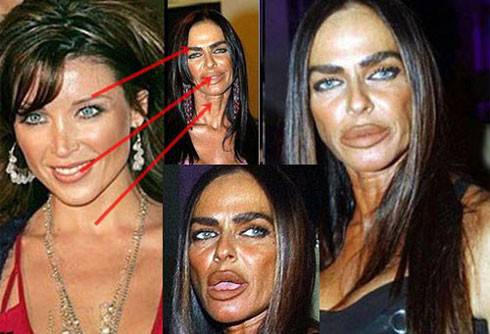 صورٌ صادمة بعد التشوّه: كانت من أجمل النجمات قبل التجميل ولكن..!