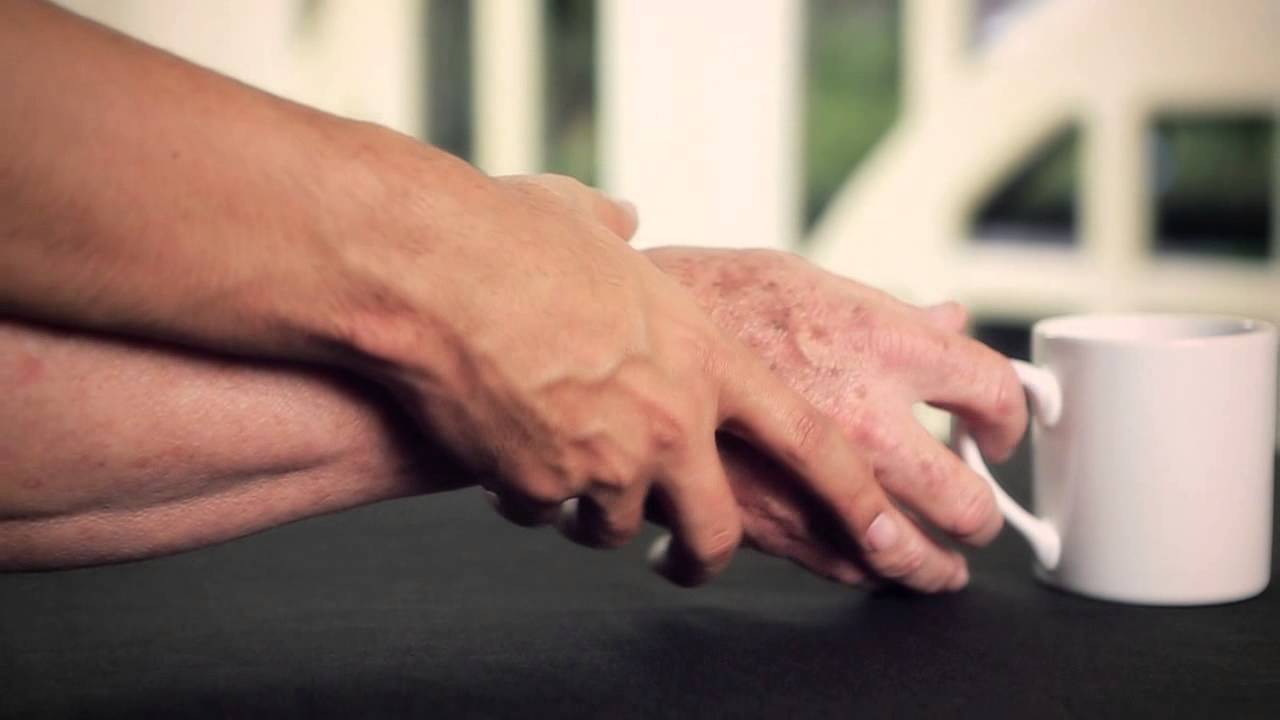 أمل جديد لمرضى الباركنسون..