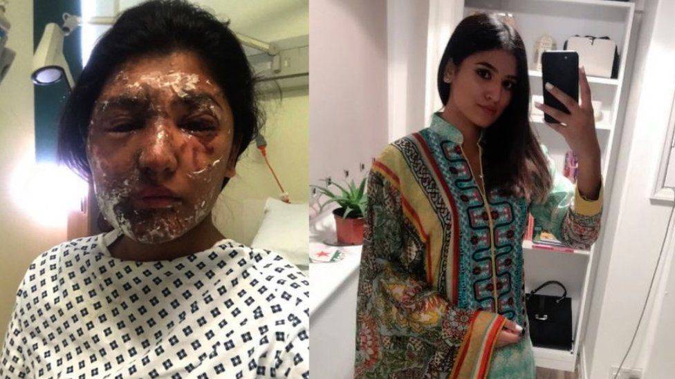 ريشام الشجاعة وثّقت فترة علاجها... نشرت صوراً بعد تعرّضها لتشوّهات وحروق!