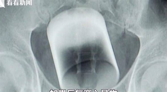 أطباء يكتشفون كأساً زجاجياً داخل أمعاء رجل!