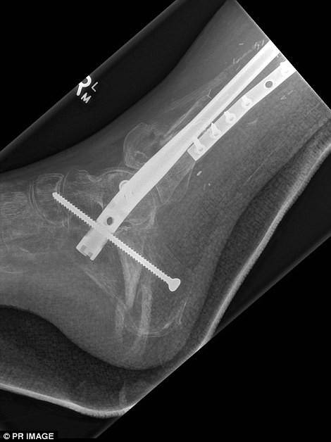 أوّل عملية جراحية بتقنية 3D.. وهذه تفاصيلها!