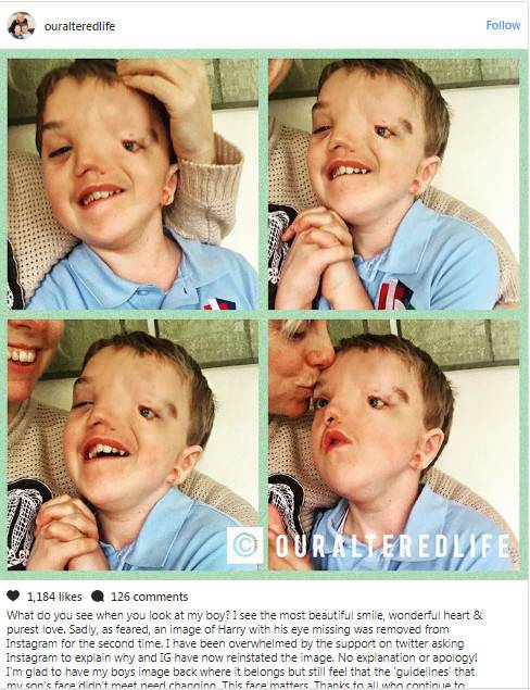 إنستغرام يحذف صورة طفل مصاب بتشوه.. ووالدته تخضع الشركة!