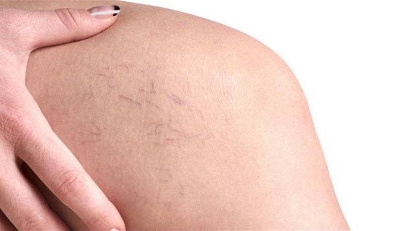 علاجات منزلية للتخلّص من 
