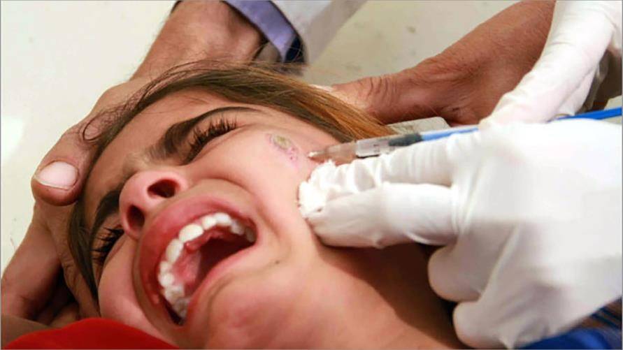 أنباء عن انتشار مرض 