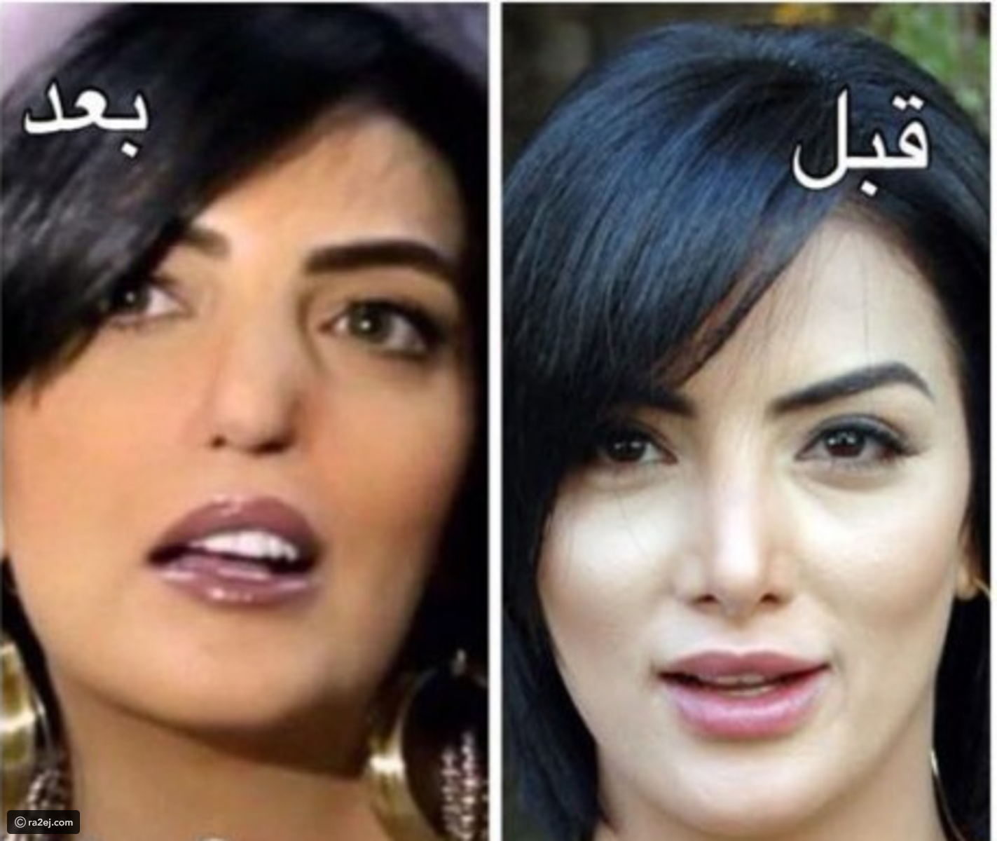 صور نجمات وقعن ضحايا عمليات التجميل...الصورة 12 محزنة جداً