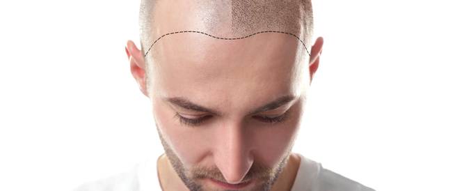 هل وجد العلماء علاجاً ثورياً للصلع أخيراً؟