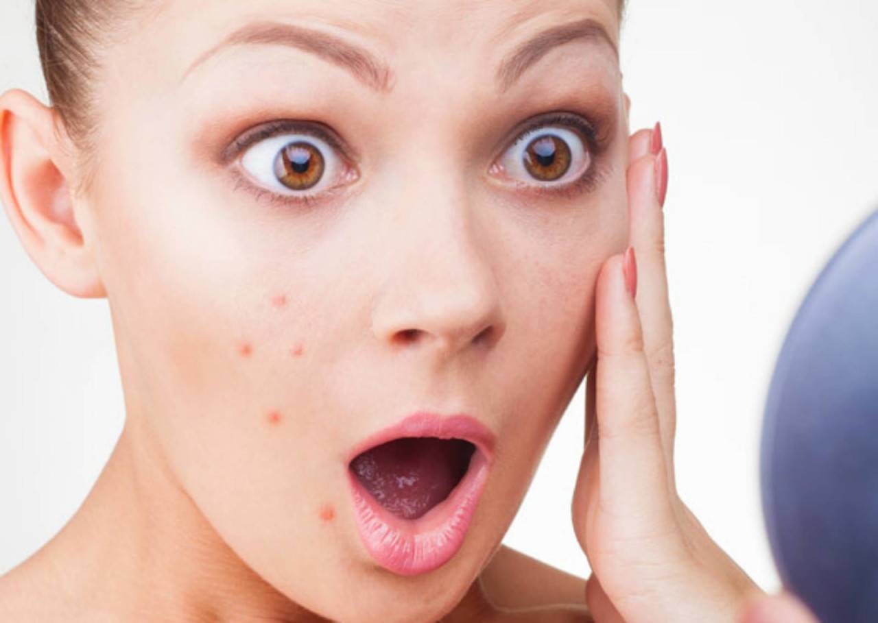 وصفة سحرية.. هكذا تعالج البثور في المنزل!