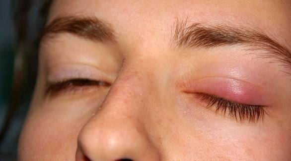 دمل العين.. أسبابه وطرق علاجه