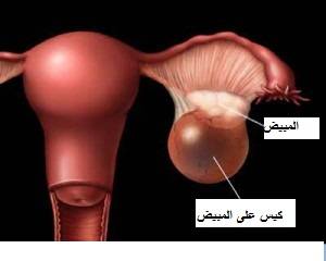 هل لديك كيس على المبيض وأنت لا تعلمين؟